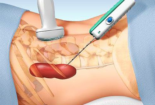 Haemodialysis