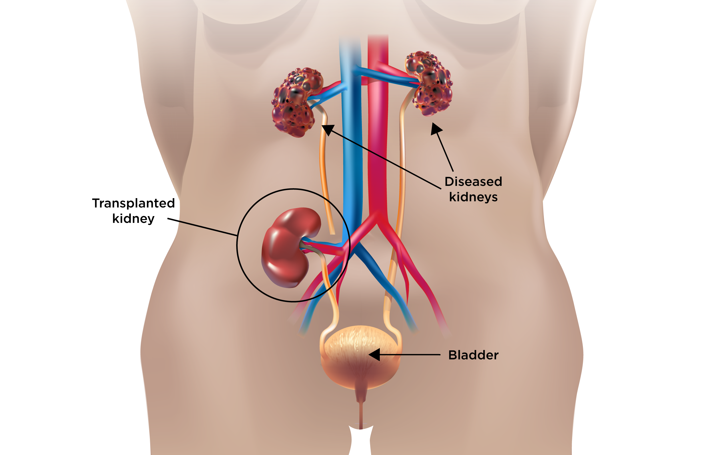 Kidney Transplant Care